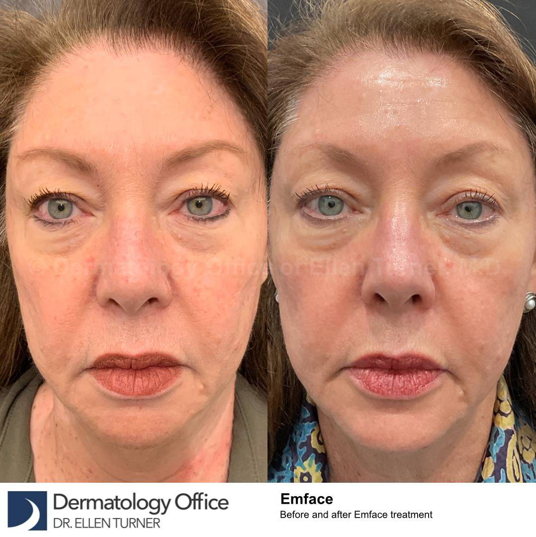 EMFACE Before and After-64 