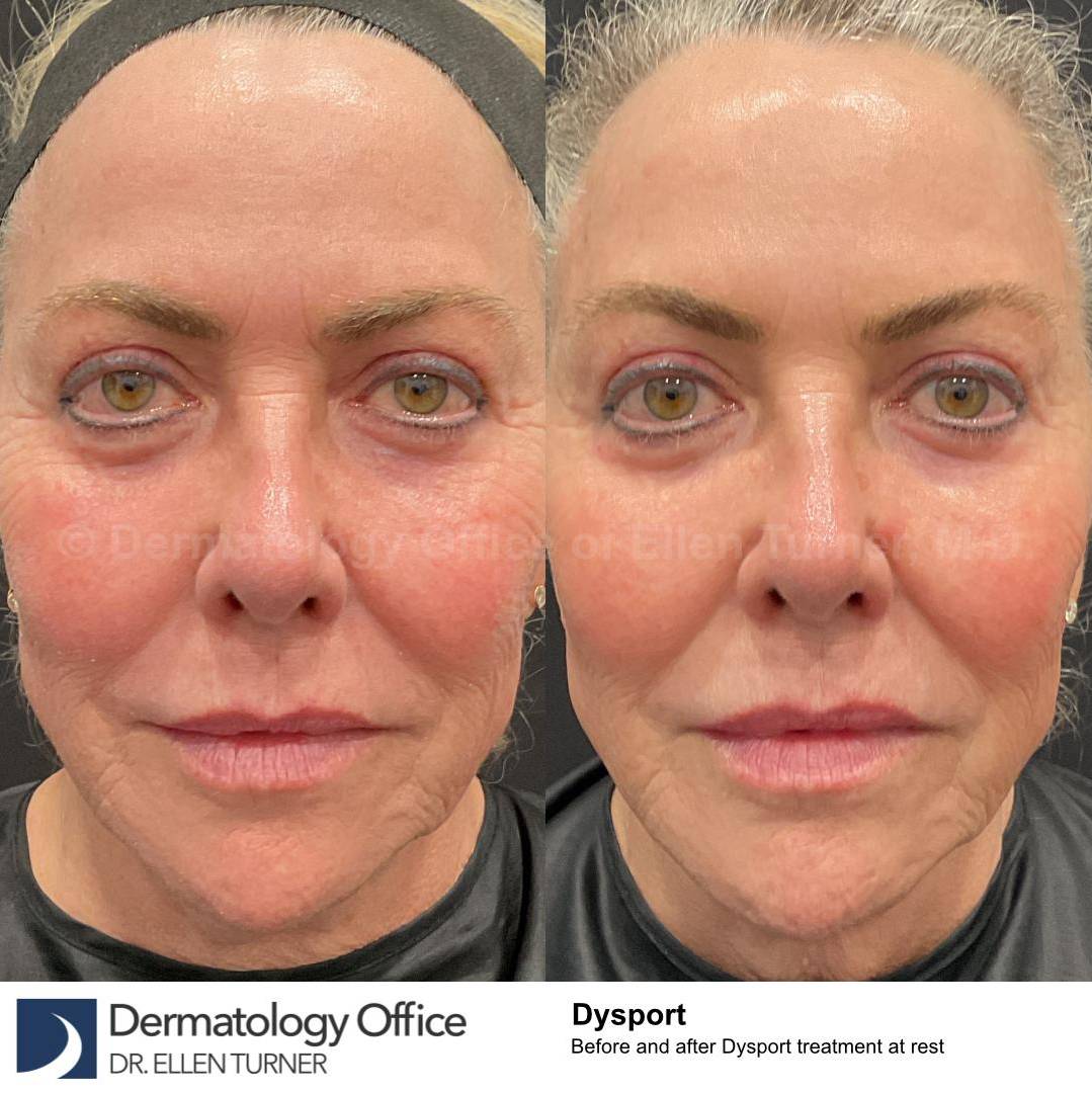 Dysport Before and after Case-8 