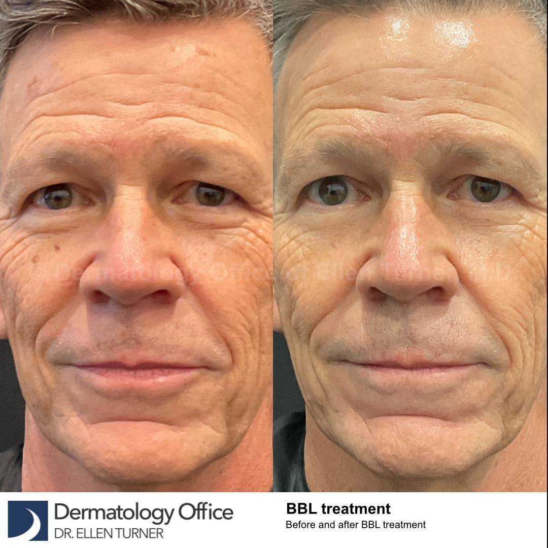 IPL-Photofacial/BBL BroadBand Laser Case-13 