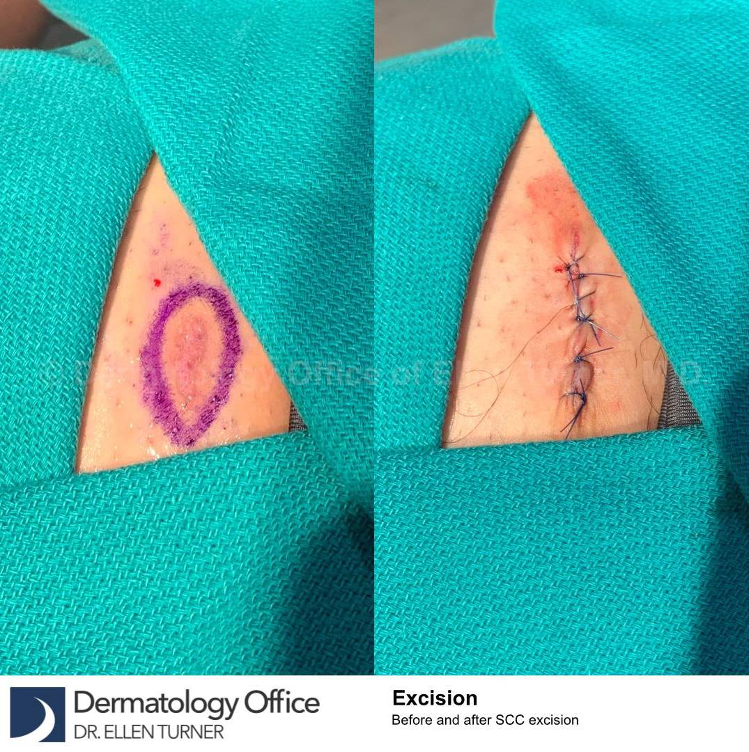 Skin Cancer (Excision) Case-107 