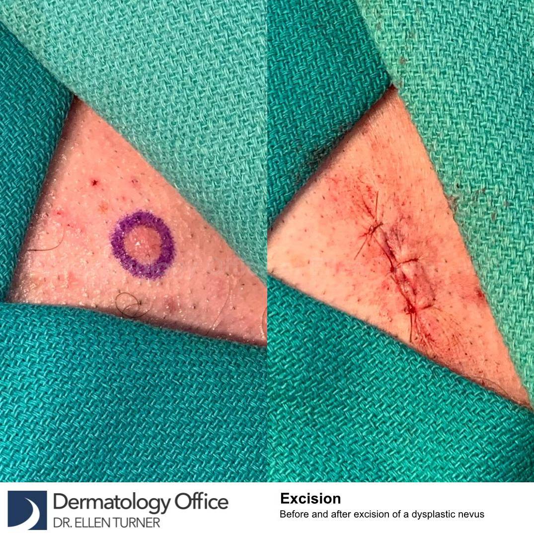 Cyst Removal Before and After Case-55 
