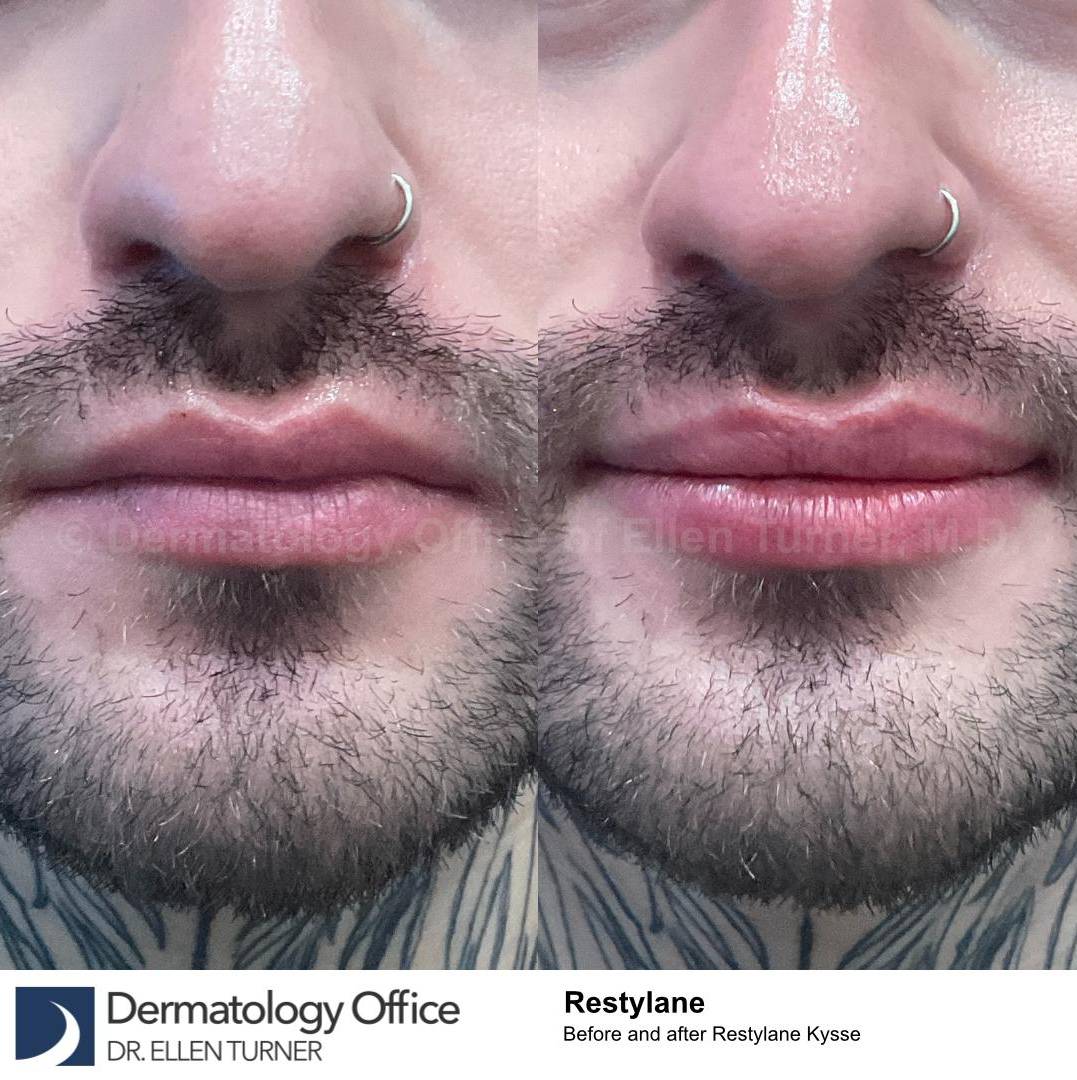 Restylane Before and After Case 33 