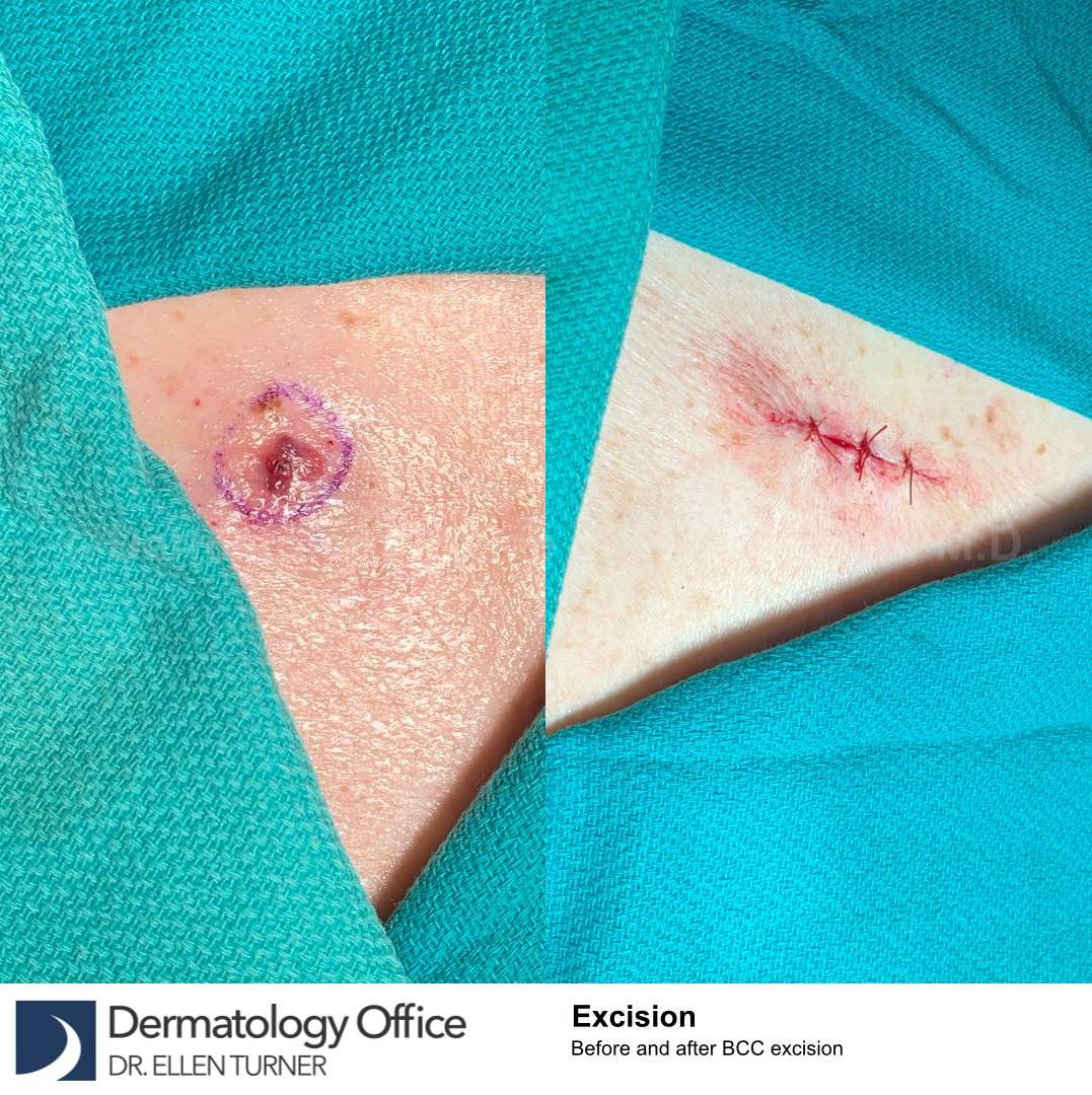 Skin Cancer (Excision) Case-108 