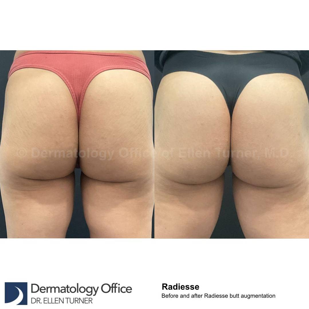 Radiesse Before and After Case 22 