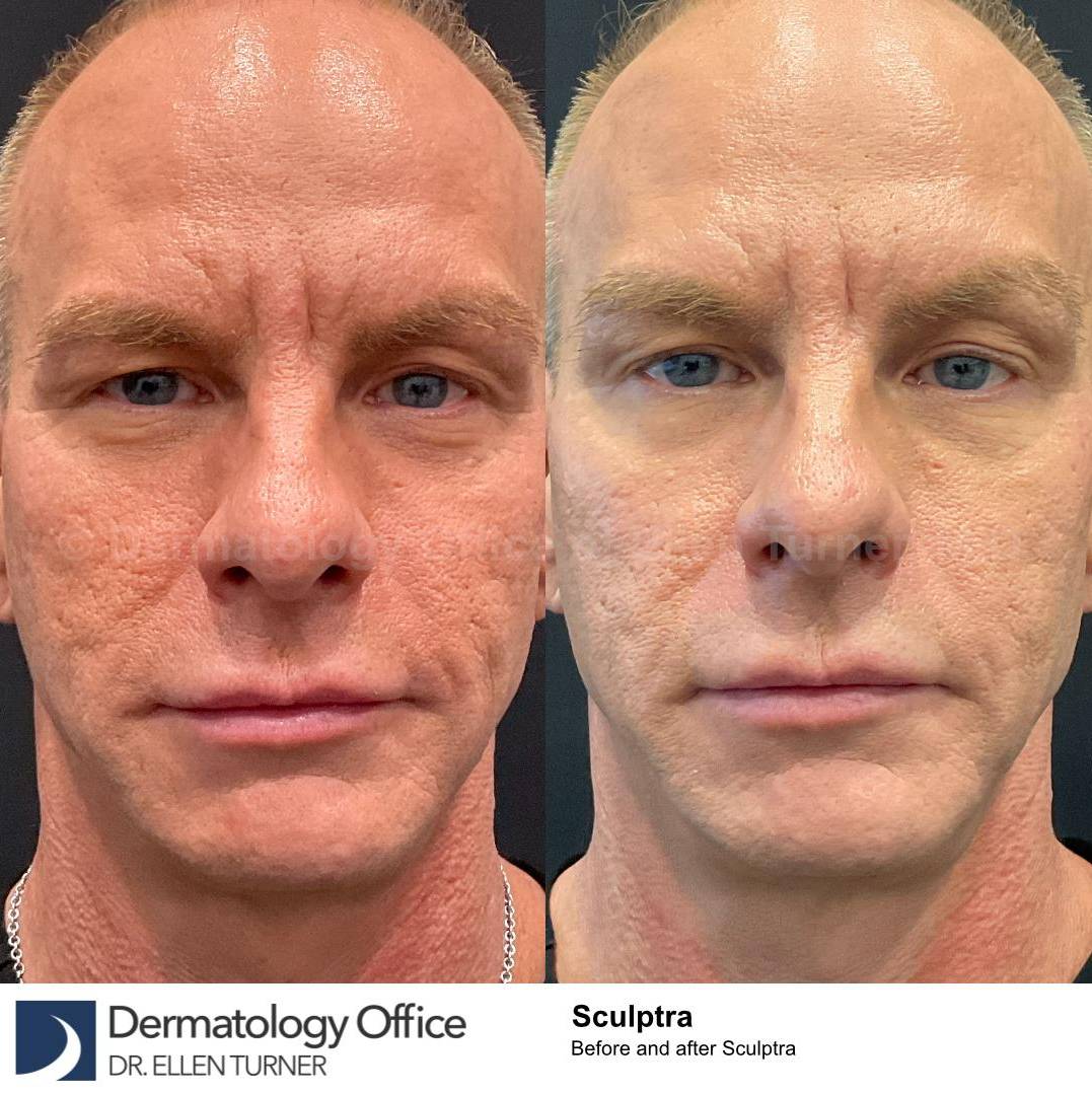 Sculptra Before and After Case 7 