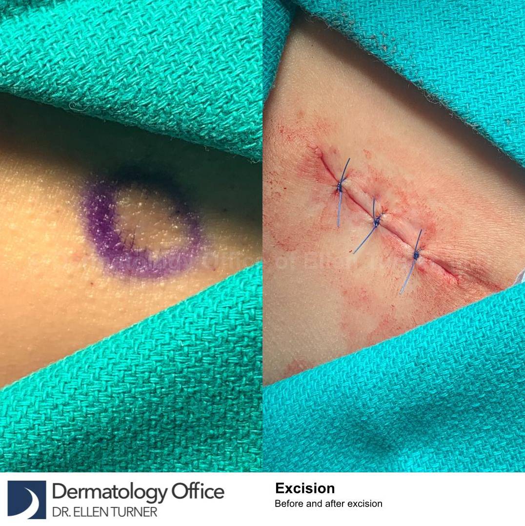 Skin Cancer (Excision) Case-109 