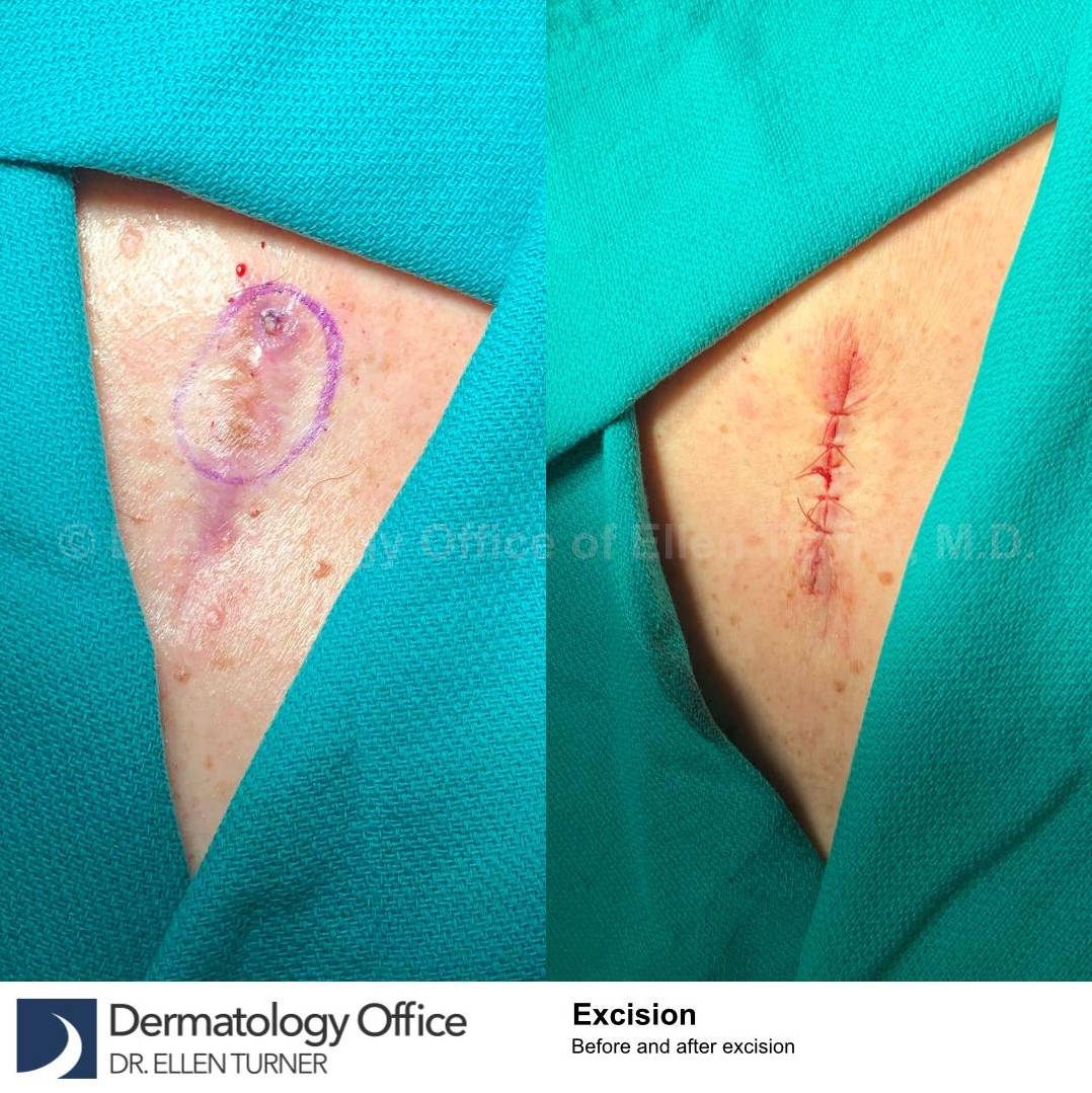 Skin Cancer (Excision) Case-110 