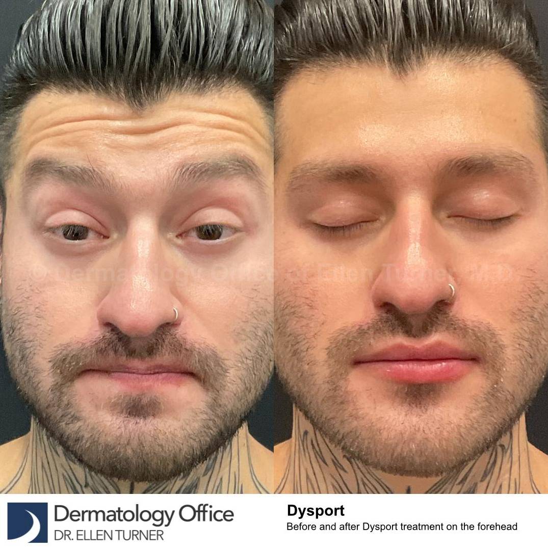 Dysport Before and after Case-9 