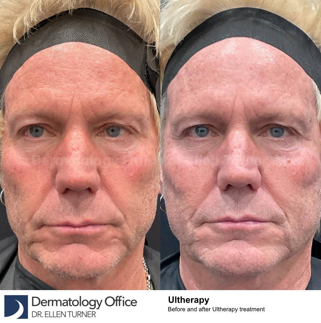 Ultherapy Before and After Case 10 