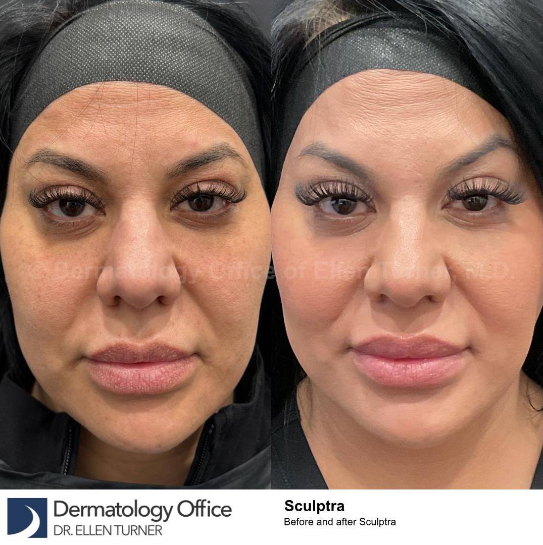 Sculptra Before and After Case 8 