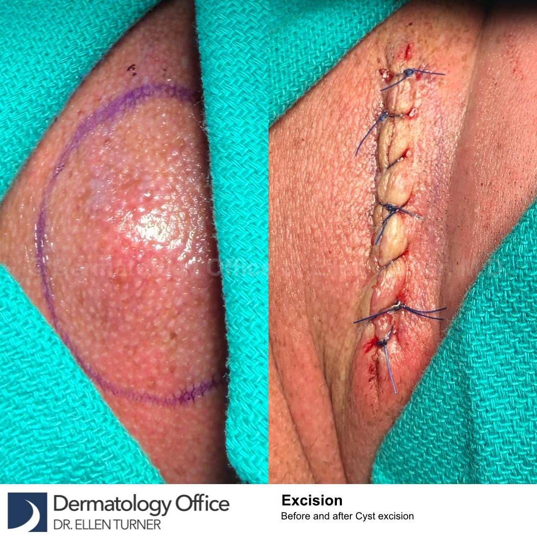 Cyst Removal Before and After Case-56 