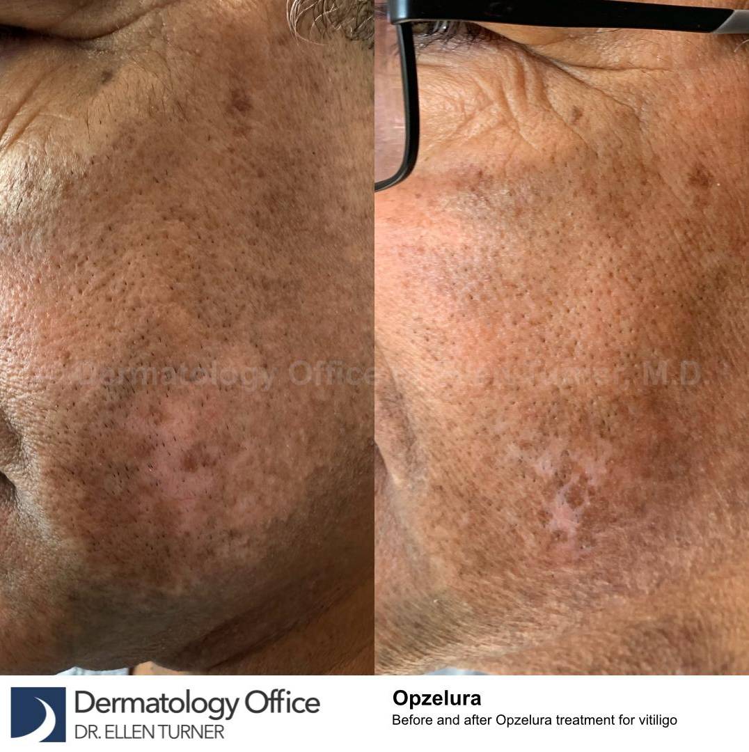 Before and After Vitiligo Case 5 