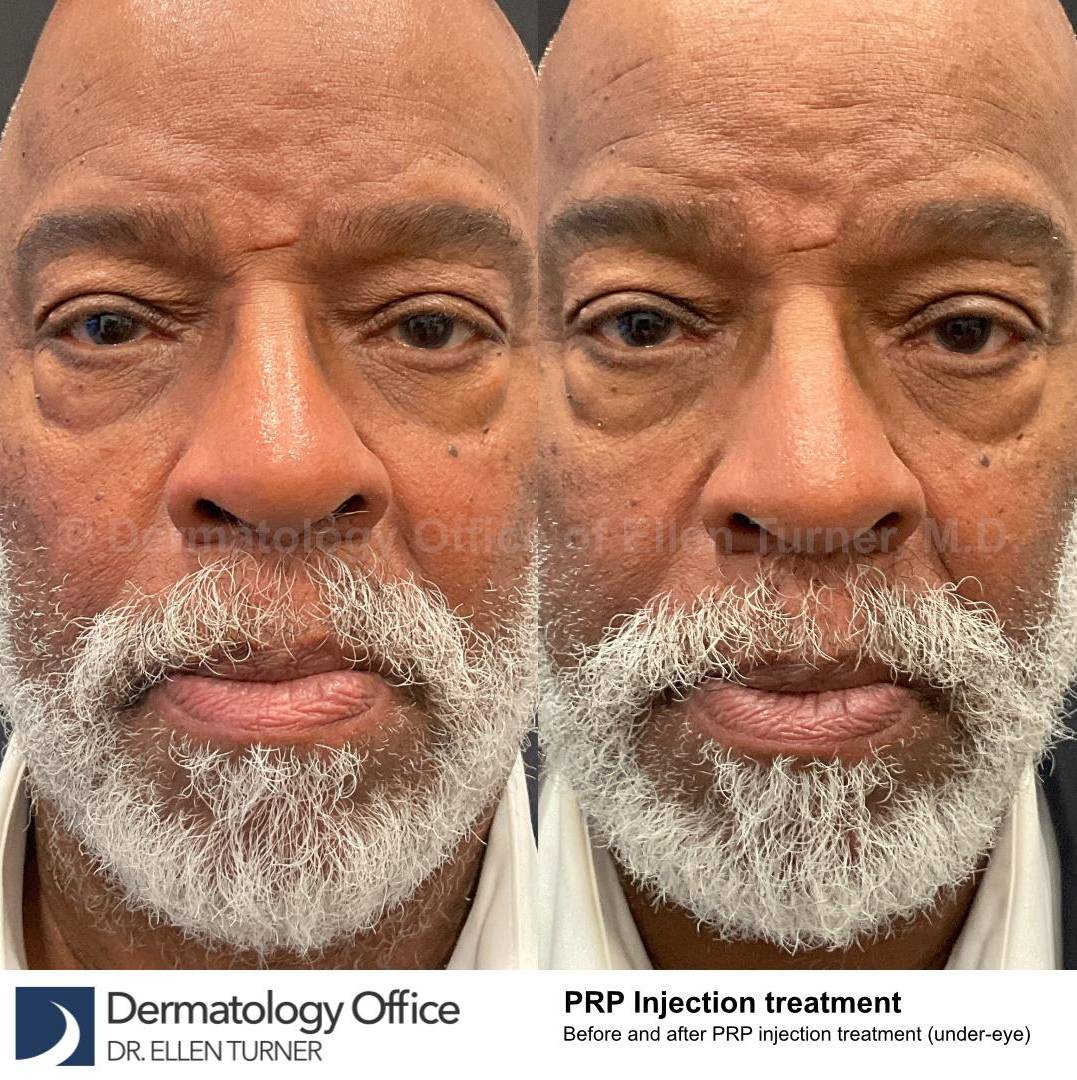 Platelet-Rich Plasma Before and After Case 11 