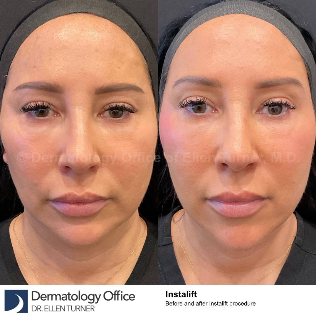 Silhouette Instalift Before and After Case-15 