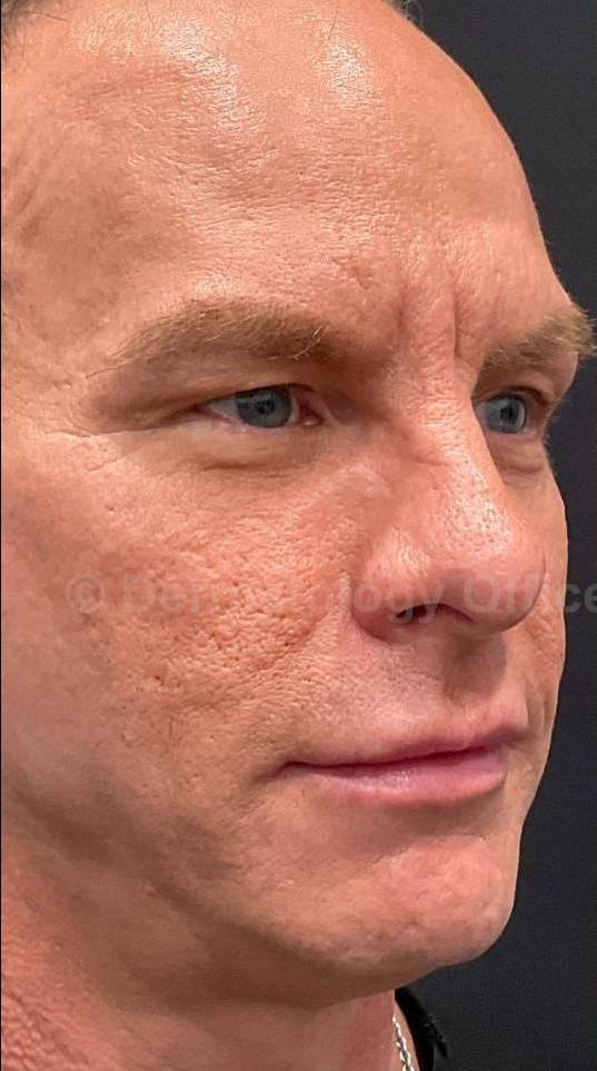 Sculptra Before and After Case 9 Before