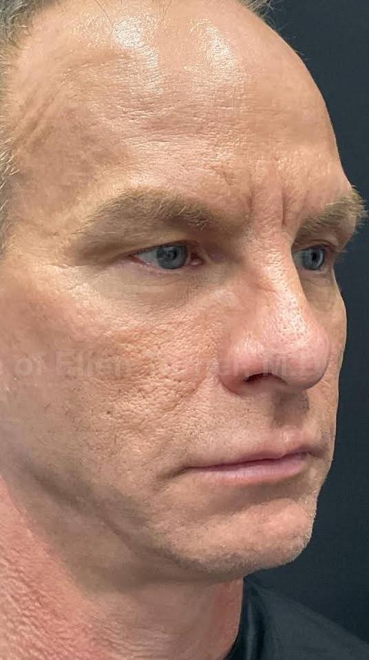 Sculptra Before and After Case 9 After