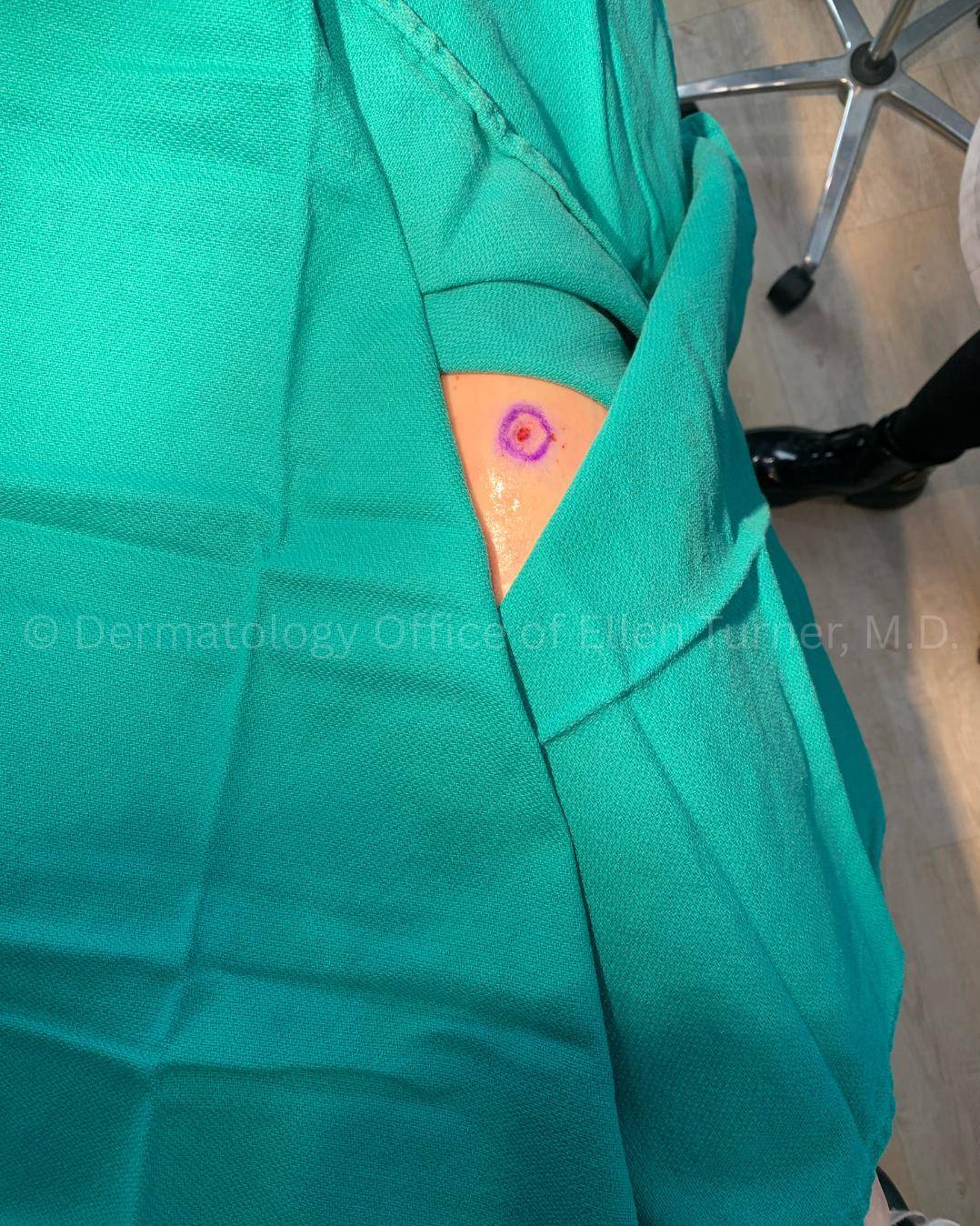 Moles (Excision) Case-2 Before