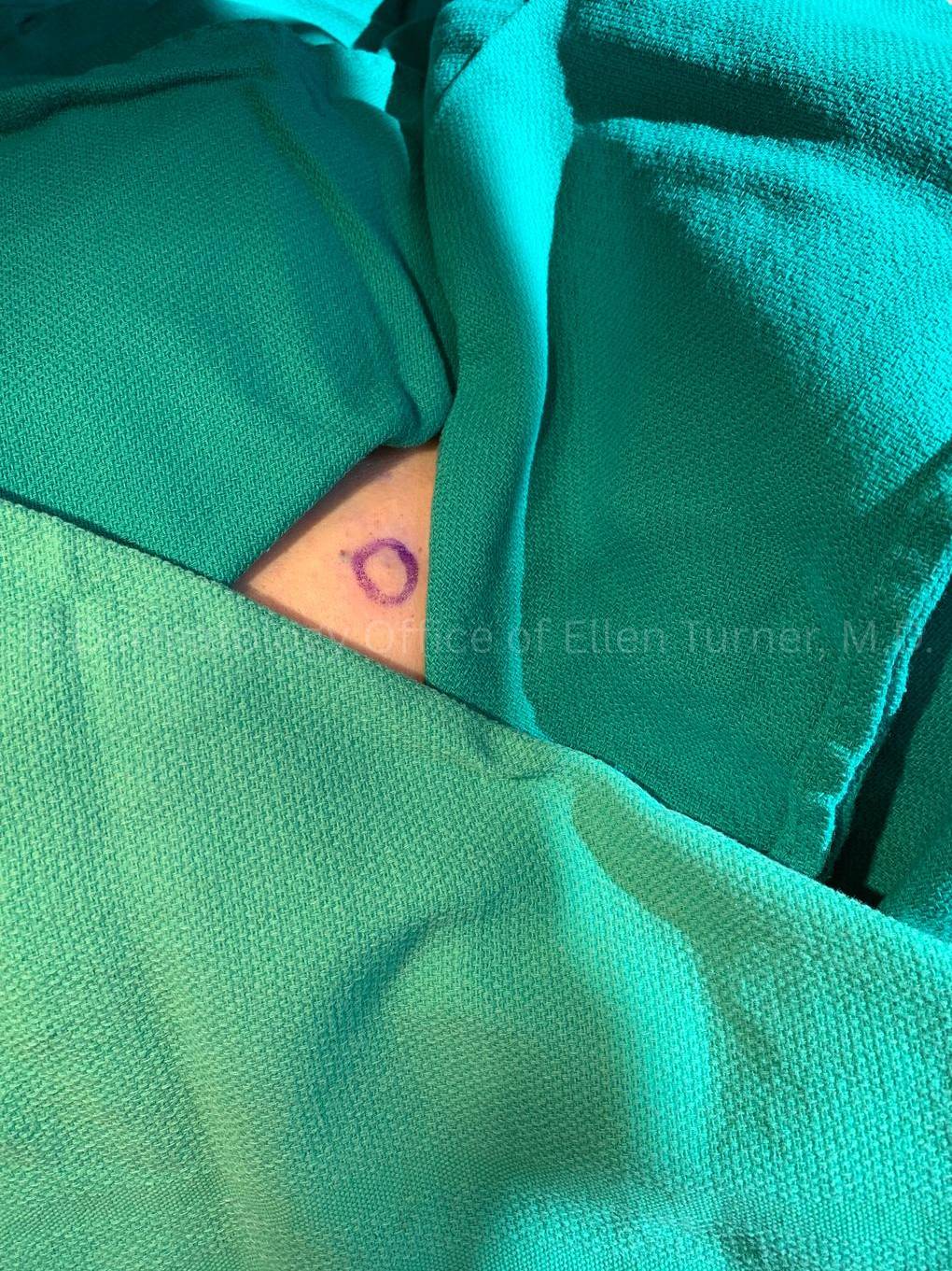 Cyst Removal Before and After Case-57 Before