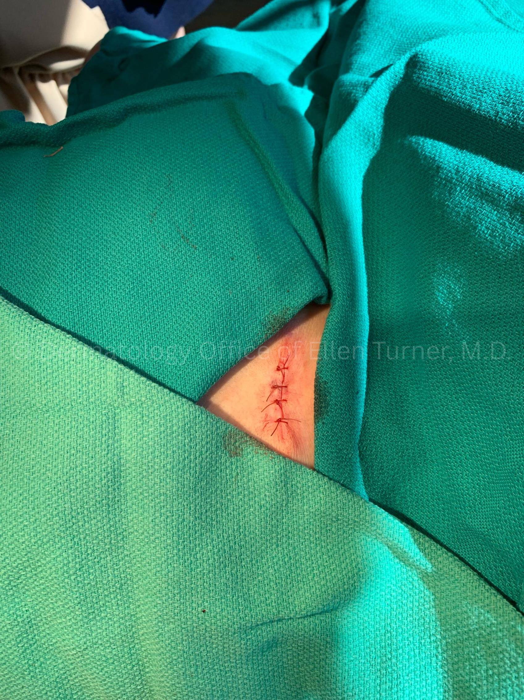 Cyst Removal Before and After Case-57 After