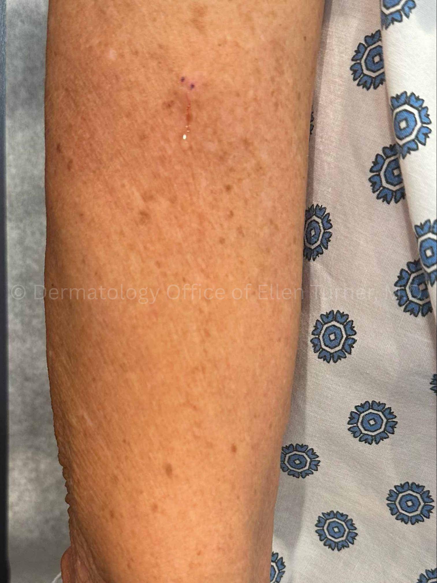 SRT-100 Before and After Case-93 Before