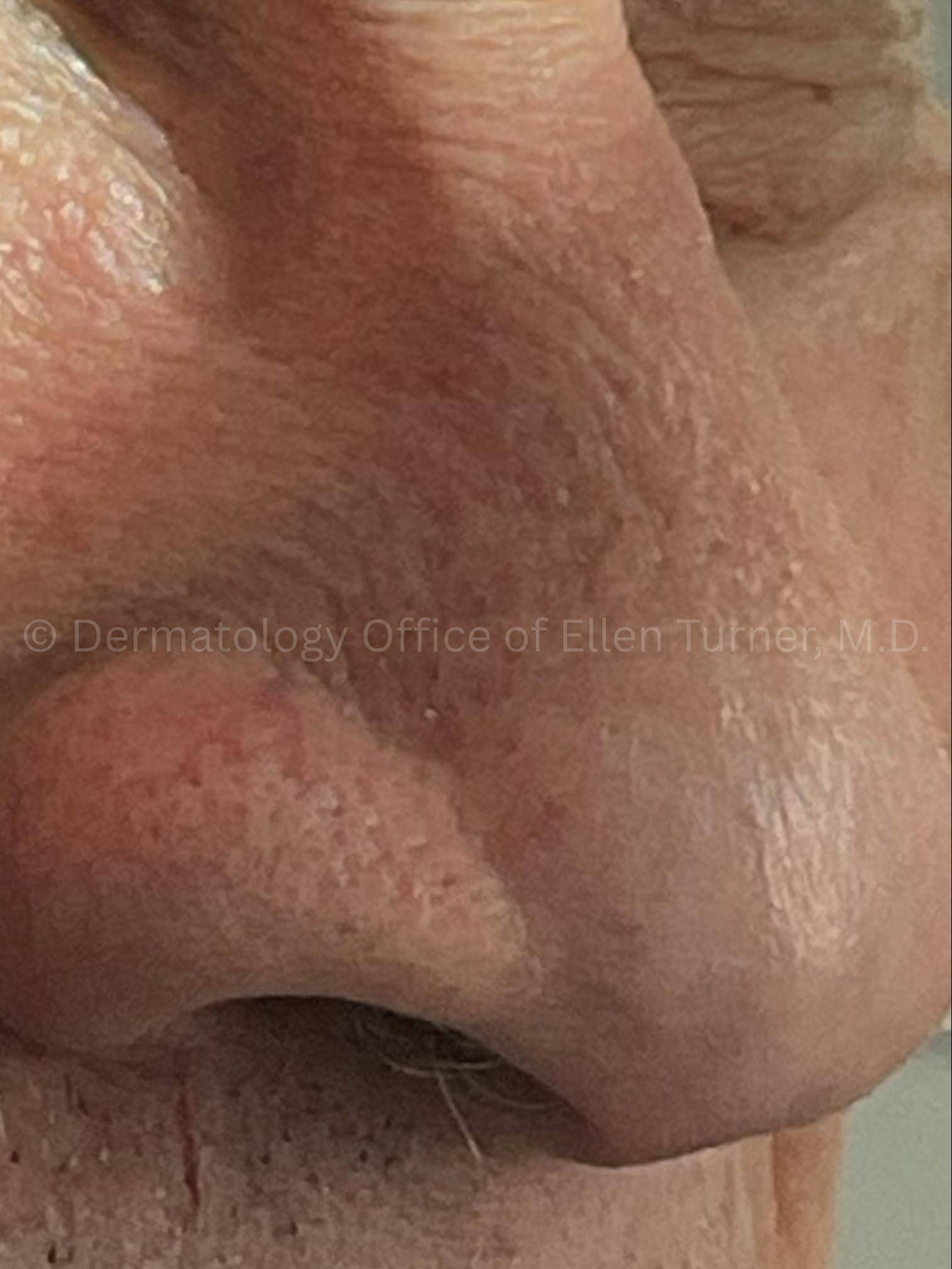 SRT-100 Before and After Case-94 After