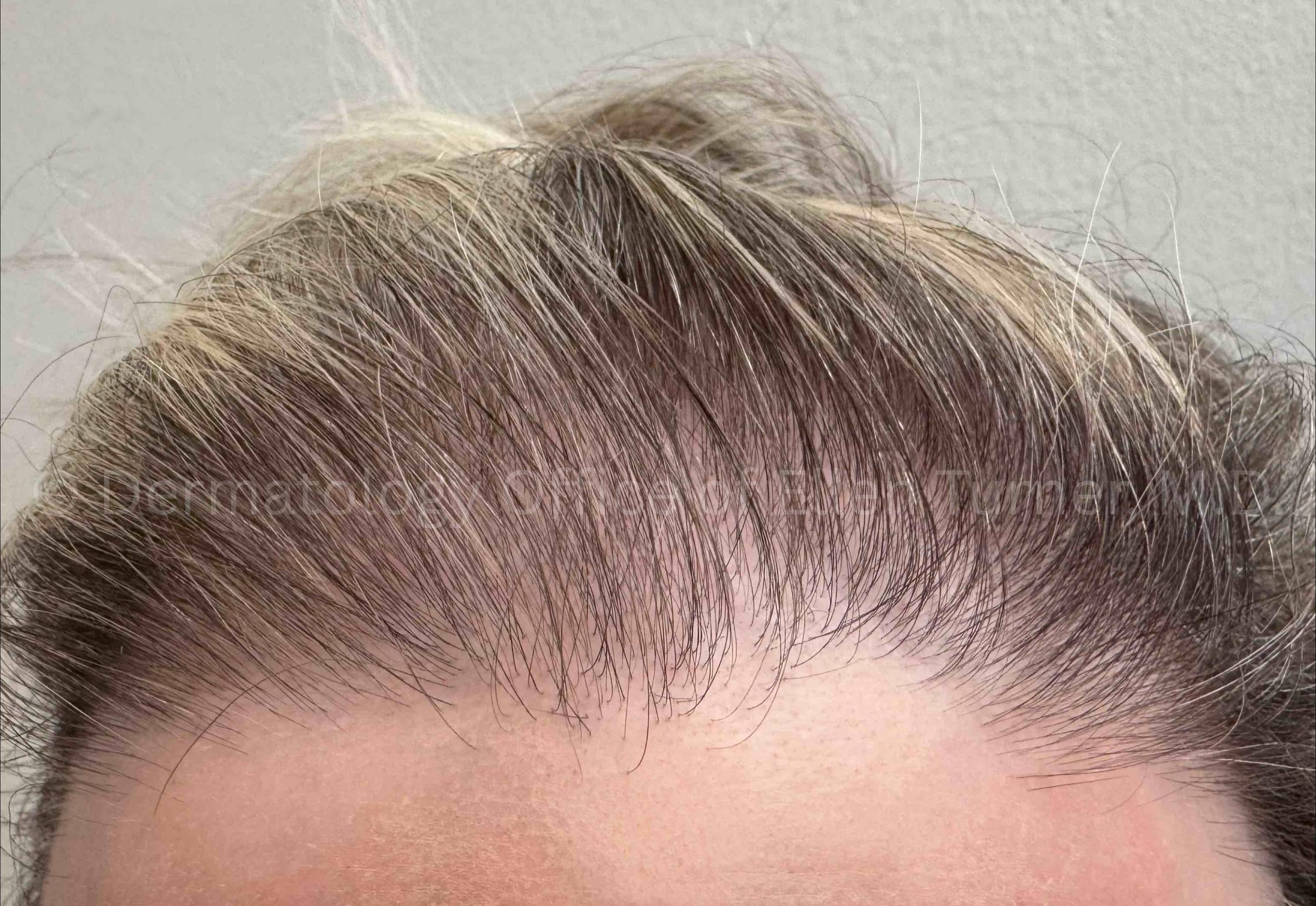 Hair Loss Before and After Case-17 Before