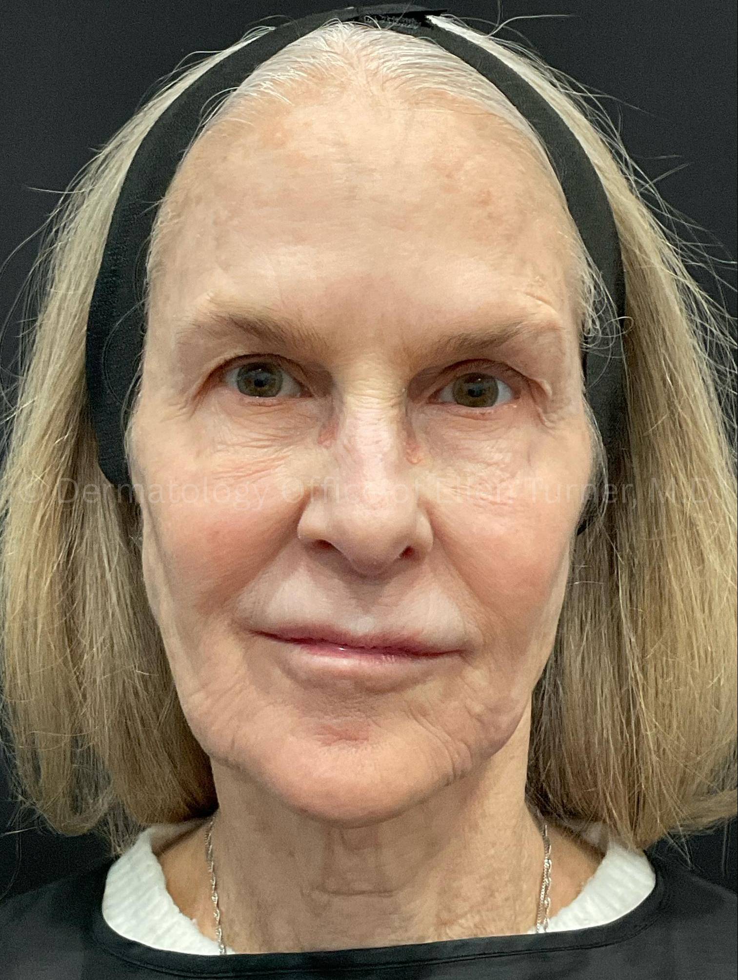 Ultherapy Before and After Case 11 After