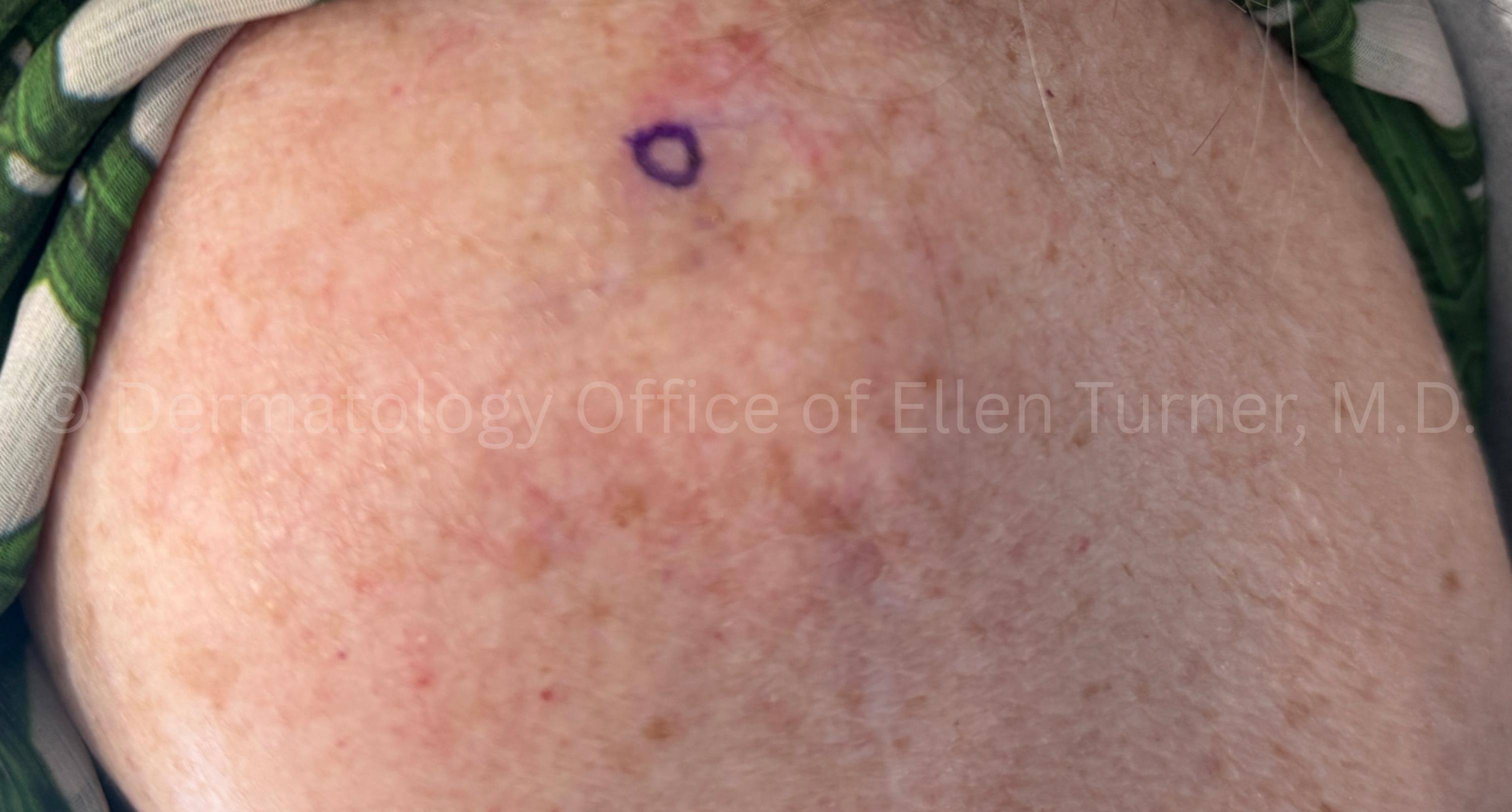 SRT-100 Before and After Case-89 Before