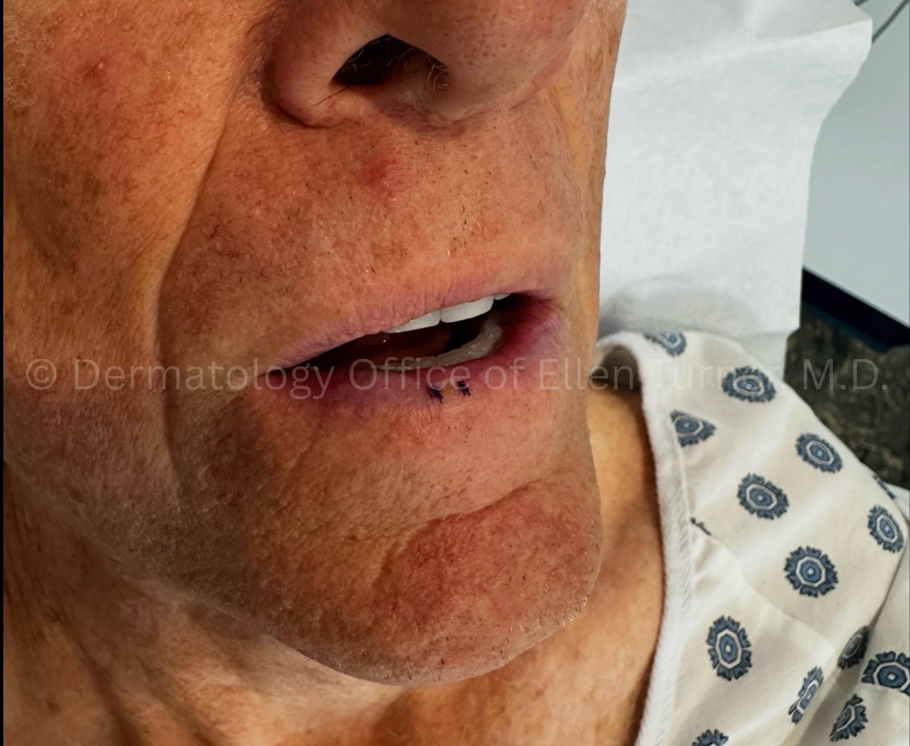 SRT-100 Before and After Case-90 Before