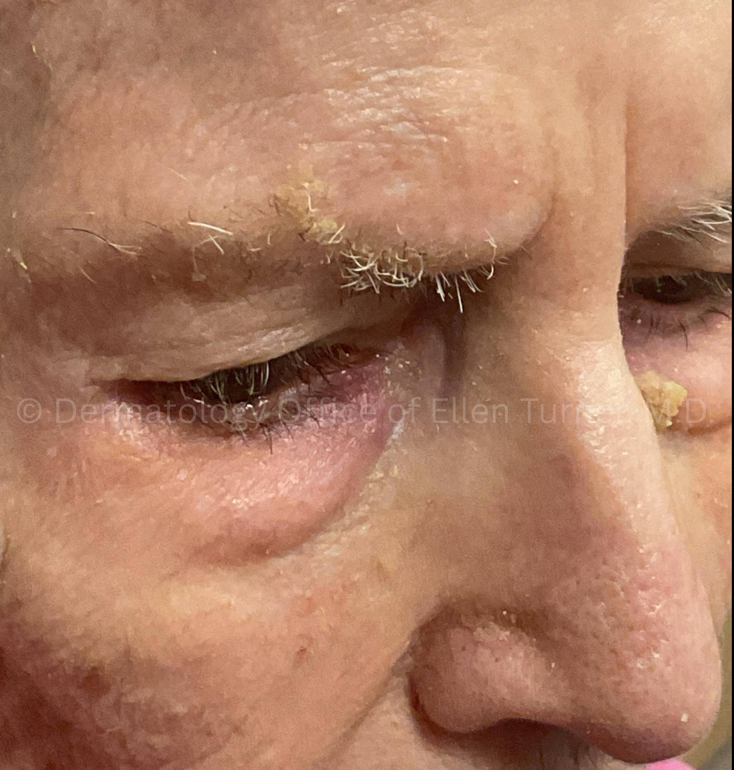 SRT-100 Before and After Case-92 After