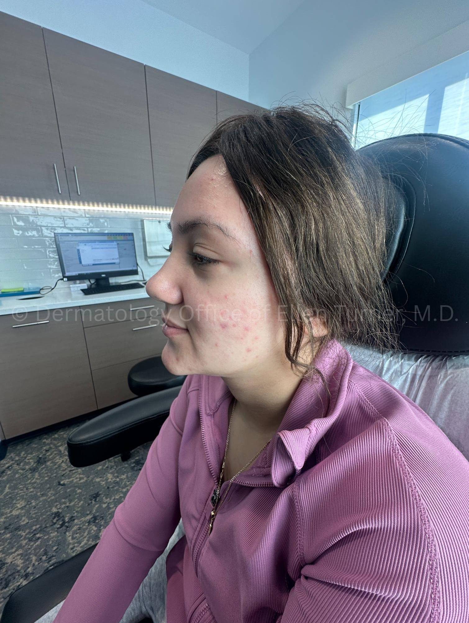 Acne Before and After Case -28 Before