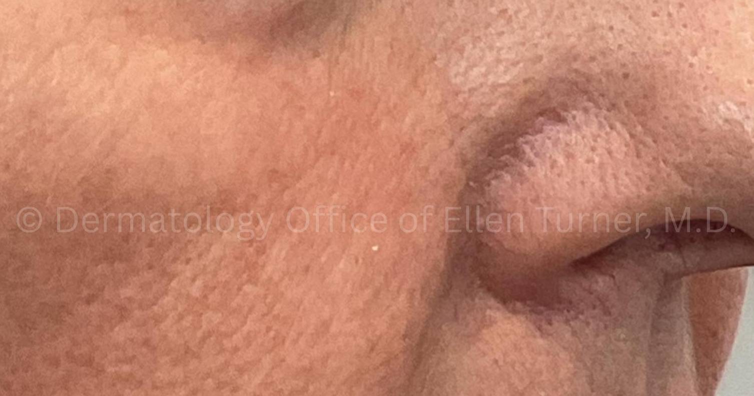 SRT-100 Before and After Case-95 After