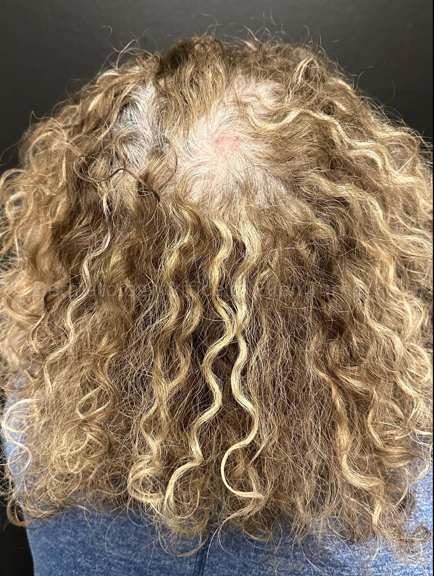 Hair Loss Before and After Case-18 Before