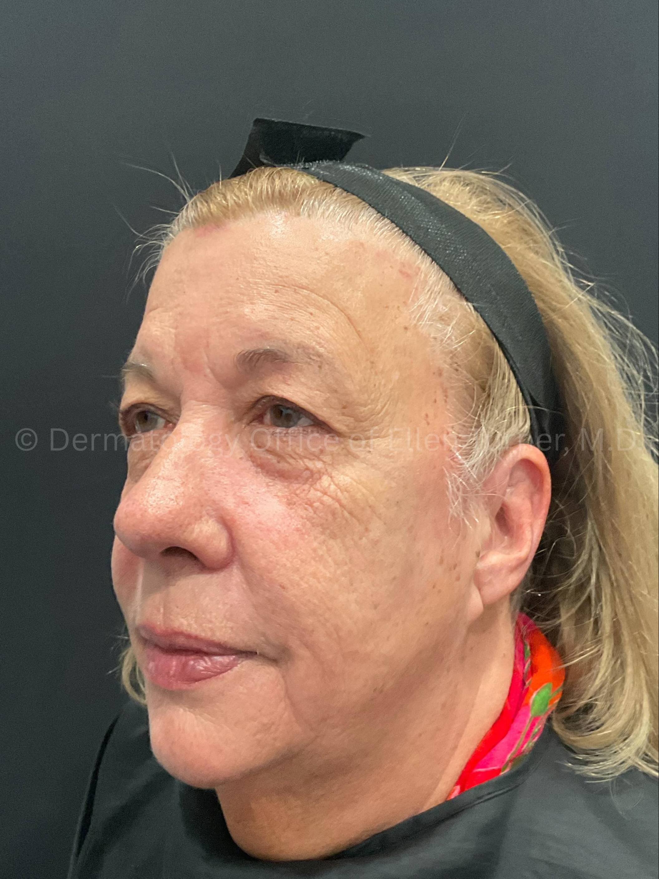 Restylane Before and After Case 34 Before