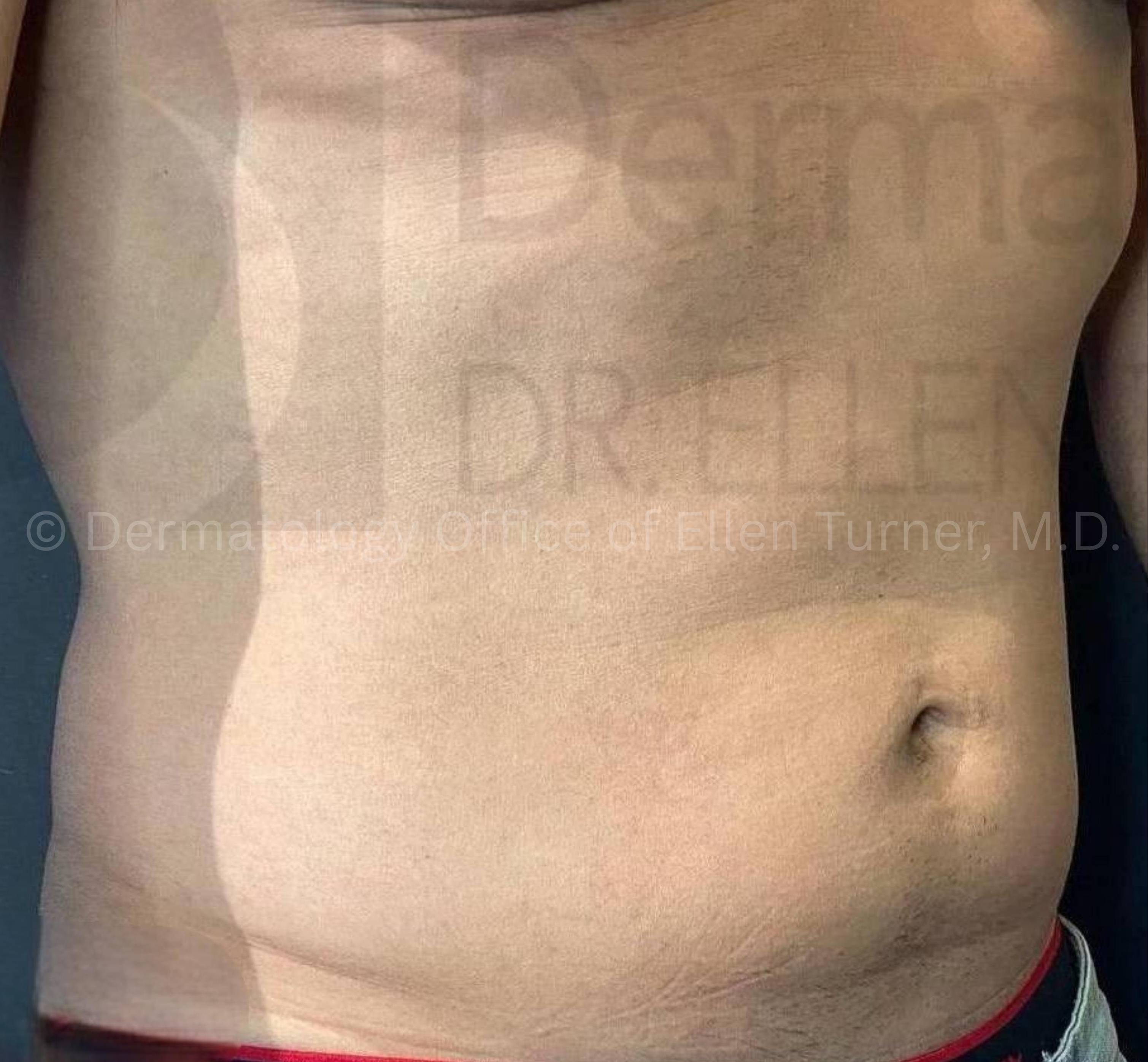 Bellafill (10 Syringes) Case 1 Before