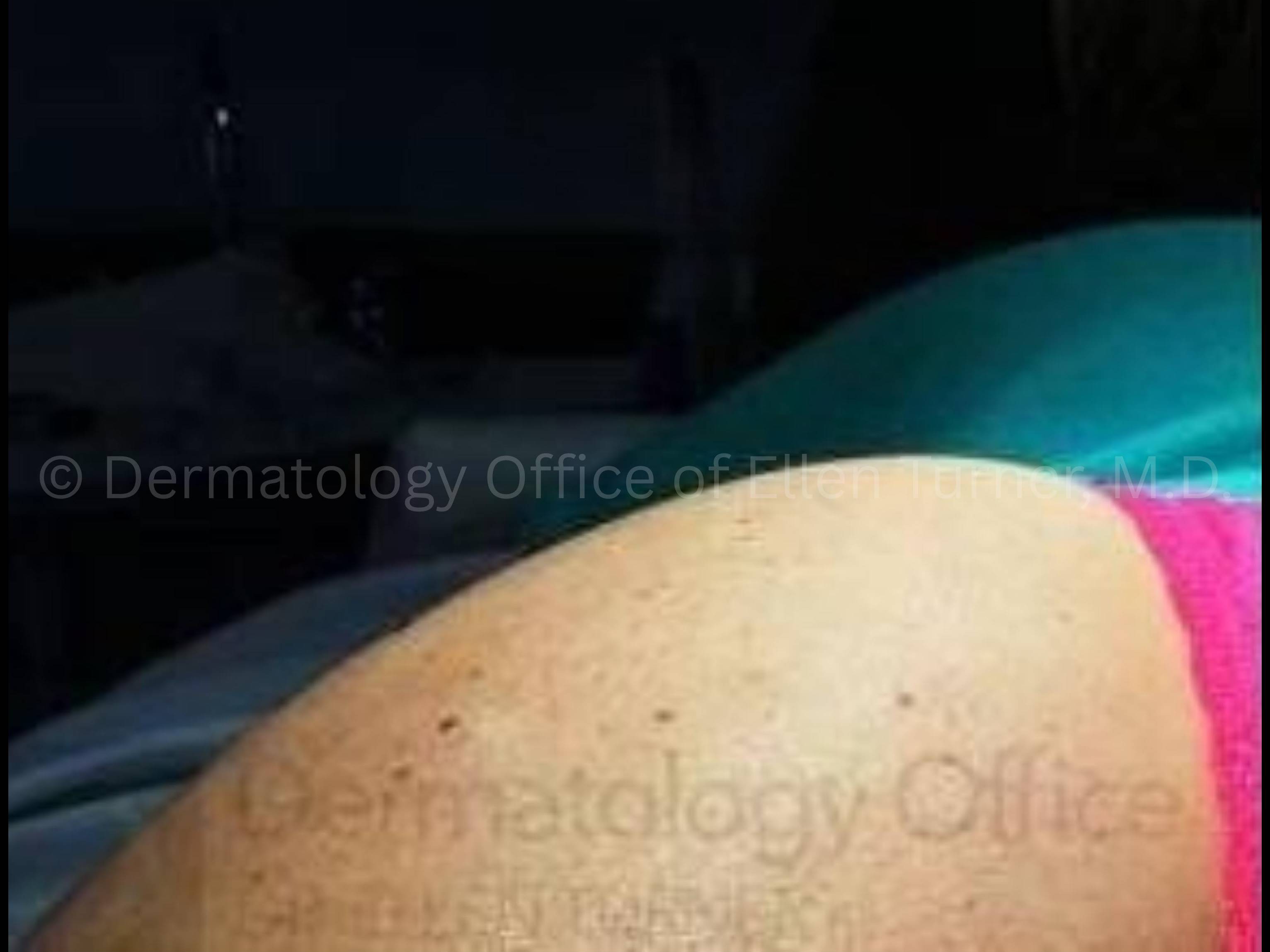 Sculptra (10 Vials) Before and After Case 1 Before