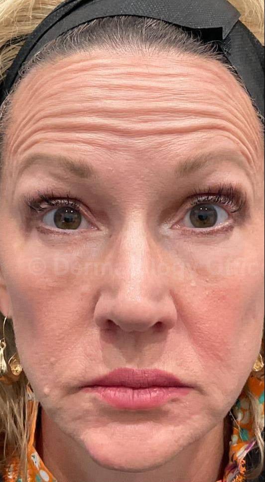 Botox Case 21 Before