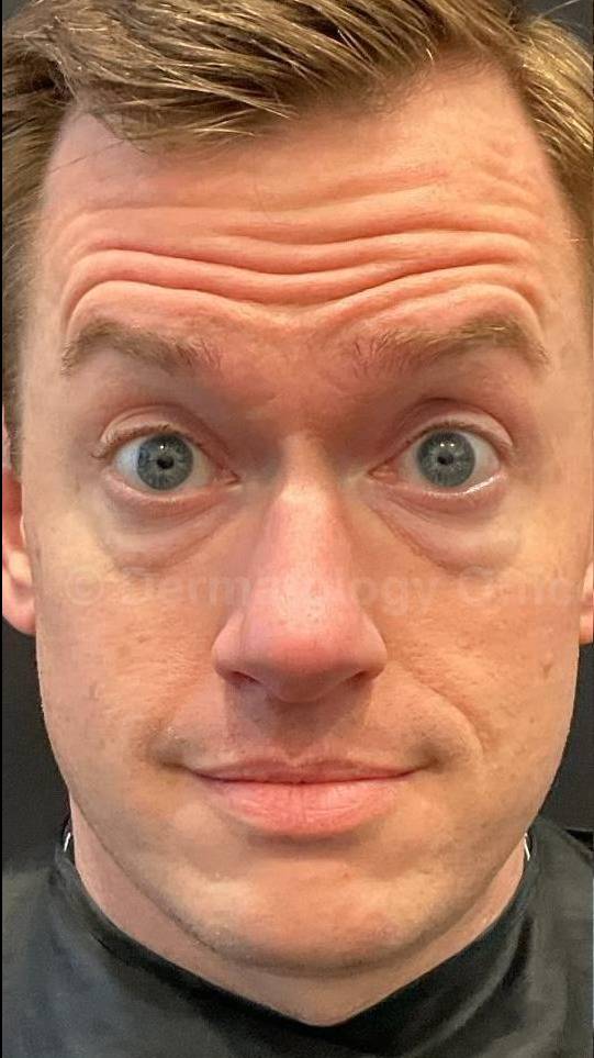 Botox Case 22 Before