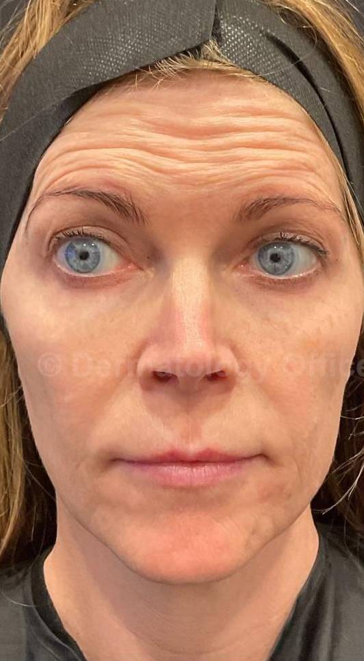 Botox Case 23 Before