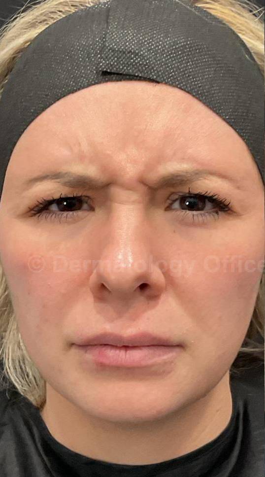 Dysport Before and after Case-2 Before