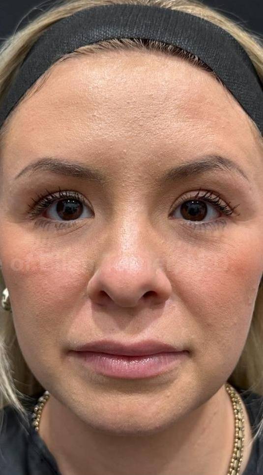 Dysport Before and after Case-2 After