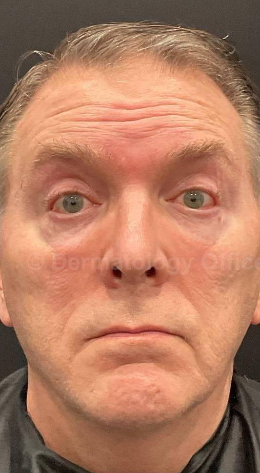 Dysport Before and after Case-4 Before