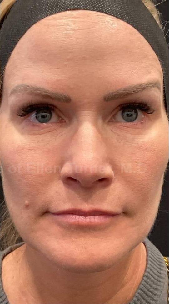 Dysport Before and after Case-5 After