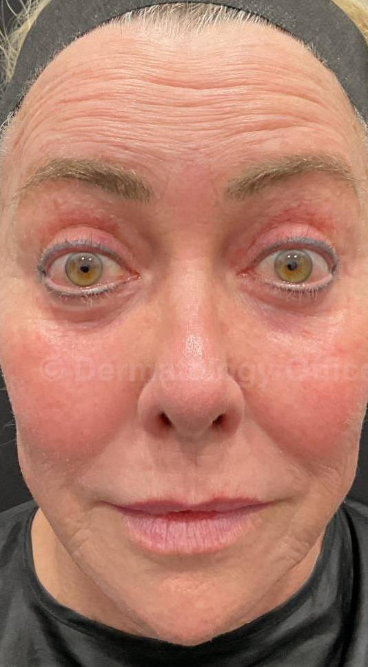 Dysport Before and after Case-8 Before