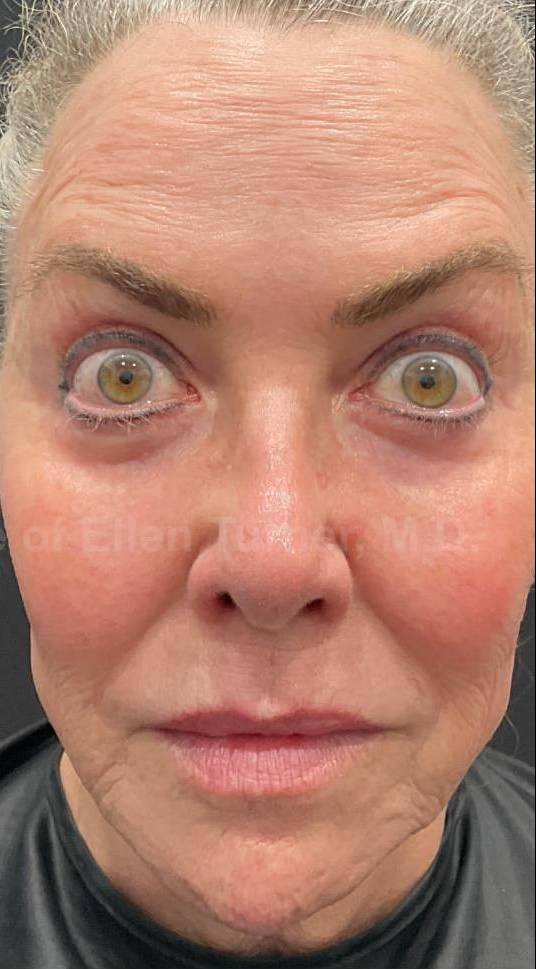 Dysport Before and after Case-8 After