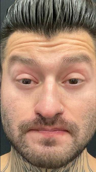 Dysport Before and after Case-9 Before