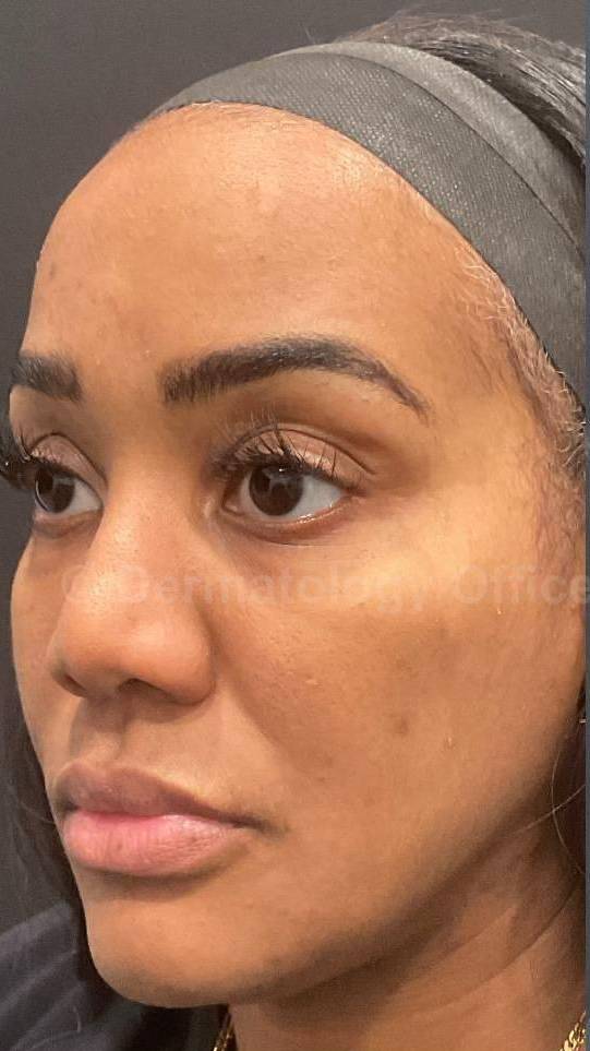 Platelet-Rich Plasma Before and After Case 10 Before