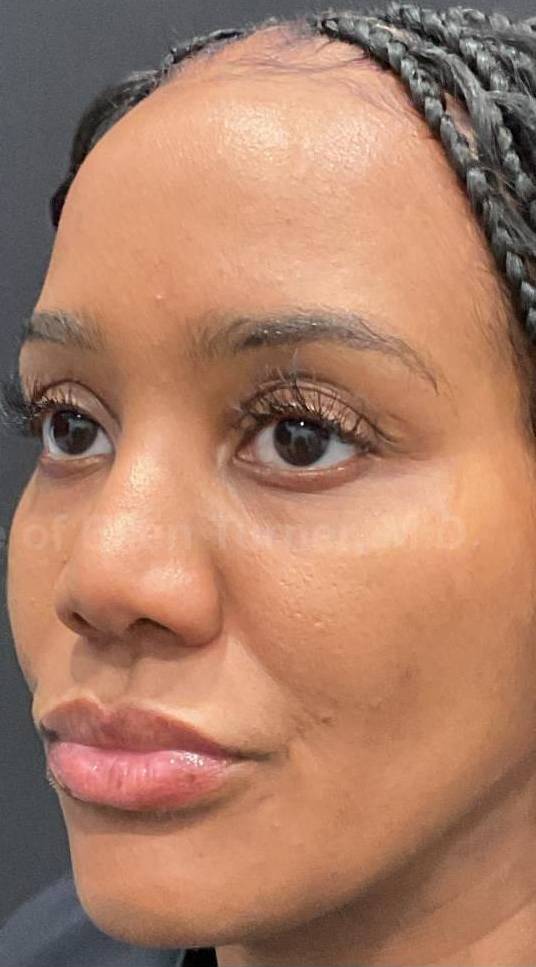 Platelet-Rich Plasma Before and After Case 10 After