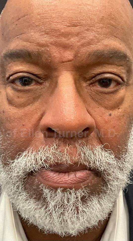 Platelet-Rich Plasma Before and After Case 11 After