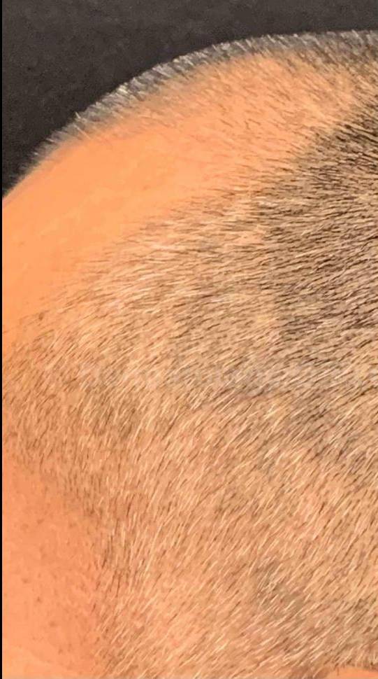 Exosomes Case-10 Before